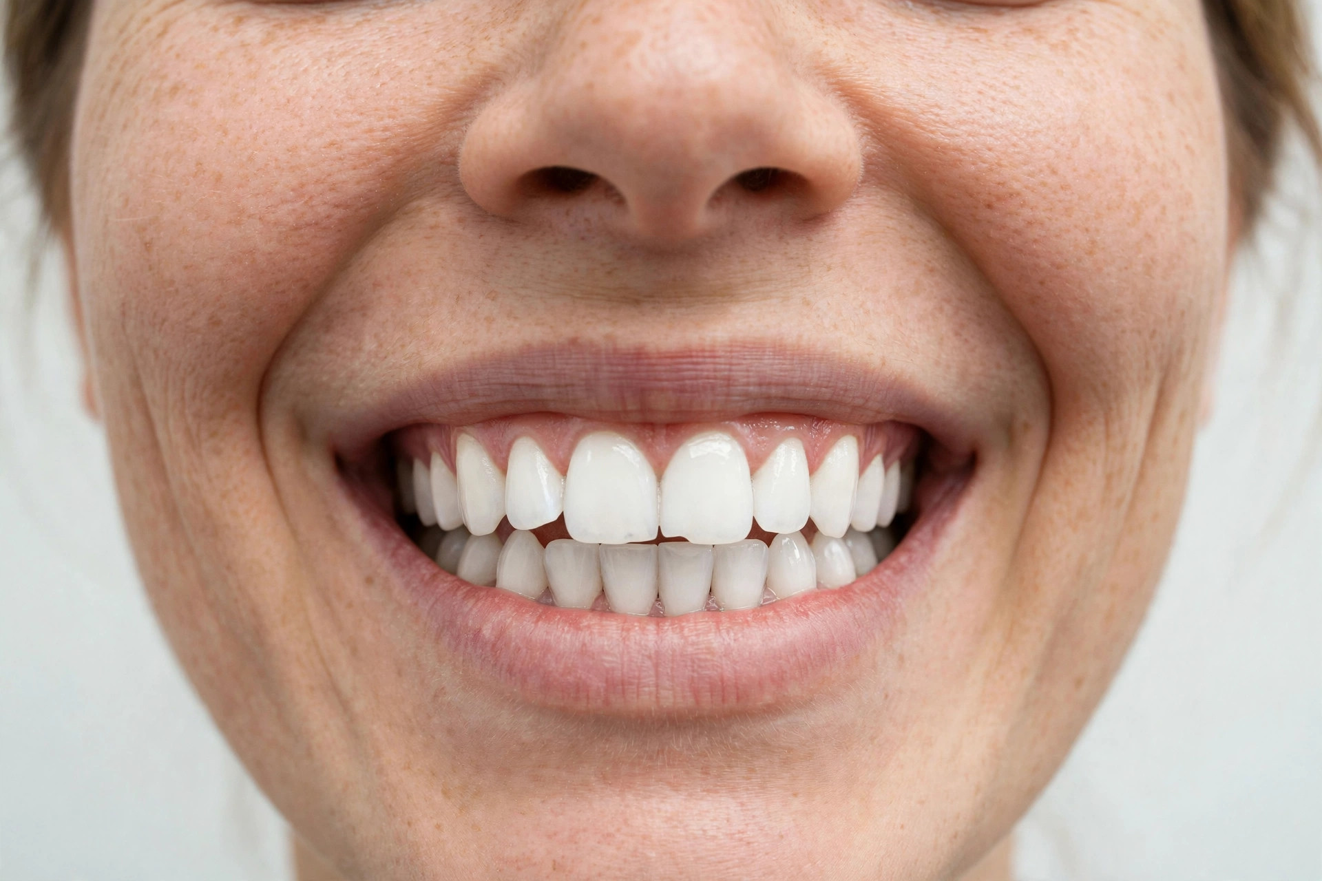 Smile after whitening treatment